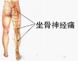 坐骨神经痛比较有效的治疗方法 坐骨神经痛如何治疗