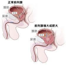 犬前列腺良性增生 良性前列腺增生的原因