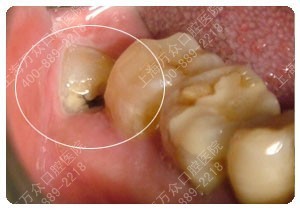 拔牙后疼痛怎么办？ 拔牙后剧烈疼痛怎么办