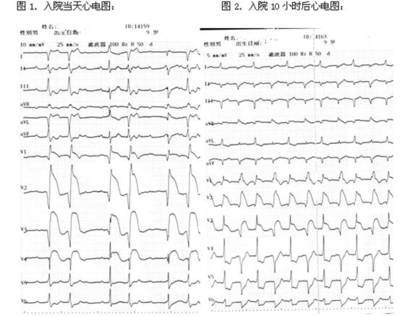 当初，我就是差点死于急性病毒性心肌炎 急性前壁心肌梗死