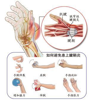 【民间偏方】一味药轻松搞定腱鞘炎 腱鞘炎民间偏方