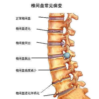 颈椎病会导致整天头晕昏沉沉吗 颈椎病会导致胸闷吗