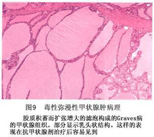 弥漫性甲状腺肿有什么症状？ 弥漫性甲状腺肿症状