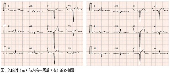 急性病毒性心肌炎治疗 病毒性心肌炎出院标准