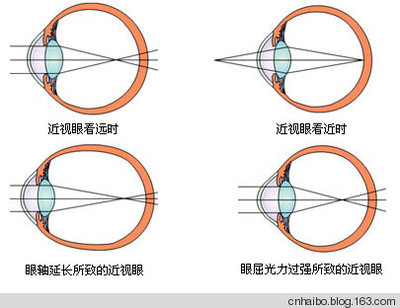 老花眼及近视眼有救了 近视眼会得老花眼吗