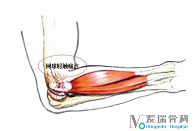 网球肘如何治疗 网球肘能自愈吗