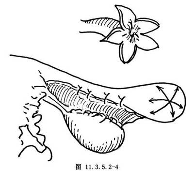 检查输卵管的方法 输卵管检查方法有几种