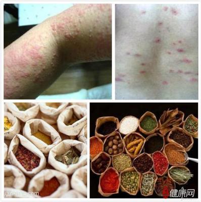 荨麻疹的有效治疗方法【慢性荨麻疹】 中医治疗慢性荨麻疹