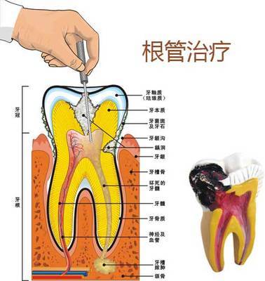 做根管治疗的步骤 根管治疗哪个环节最疼