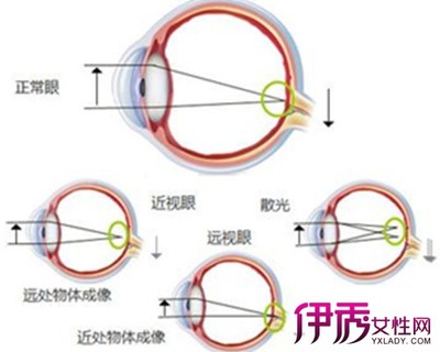 怎样治疗散光 散光可以治疗好吗