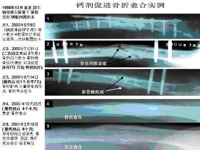 骨折病人吃什么好 骨折后怎样恢复得快