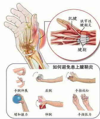 鼠标手如何治疗 鼠标手是腱鞘炎吗