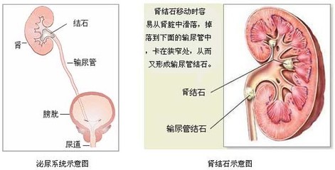 肾结石是怎么形成的 肾结石排出后图片