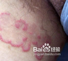 大腿肚内侧股癣 大腿内侧股癣好治吗