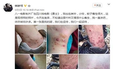 林妙可显赫身世之谜(图)一 林妙可被毒虫咬伤图片