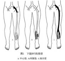 深静脉血栓的表现 深静脉血栓消失的原因
