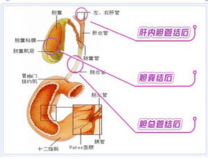 截石术与排石汤 胆结石手术后煲什么汤