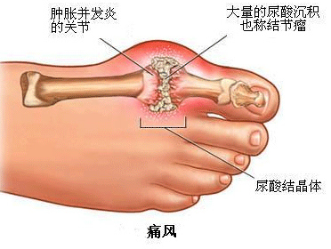 我是如何发现桔梗治疗痛风病的 澳门发现痛风千年秘方