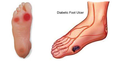 糖尿病足的护理措施 糖尿病足怎么治