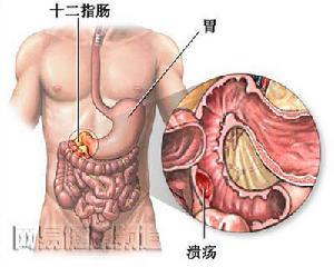 上消化道出血怎么办？ 上消化道出血