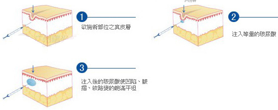 如何丰脸？玻尿酸丰脸的优点介绍_厦门整形 玻尿酸丰脸多少钱