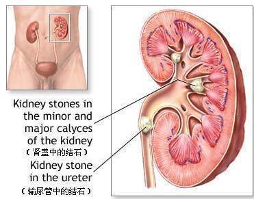 肾结石最好的治疗方法 肾结石怎样治最好偏方