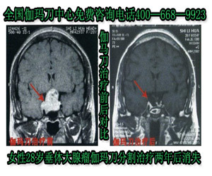 垂体瘤 脑垂体瘤的早期症状