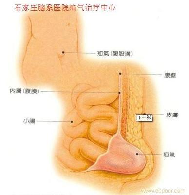 疝气症状和治疗 小儿疝气是怎么引起的