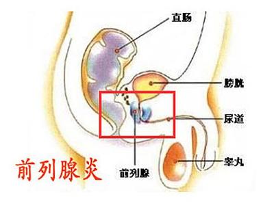 “锯箭疗法” 前列腺炎的自我疗法