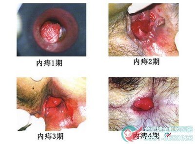内痔的得病原因有哪些肛肠专家介绍 女子肛肠专家