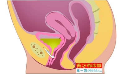 对治紧张、压力的方法 压力性尿失禁治疗方法