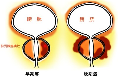 前列腺癌骨转移晚期 前列腺癌骨转移生存期