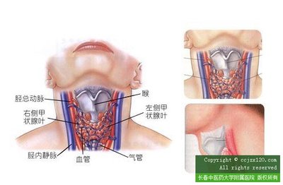 甲状腺肿大原因是什么 甲状腺肿大手术