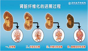 中药复方从标实论治肾脏纤维化的实验研究进展 肾脏纤维化治疗