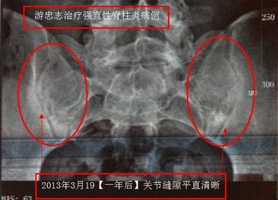 骶髂关节炎康复病例【一】 治骶髂关节炎多少钱