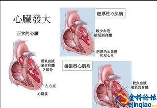 请问儿童患有心肌炎是什么症状 儿童心肌炎有什么症状