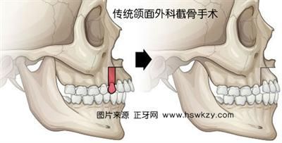 脸型矫正化妆造型术——方脸型 拔牙矫正脸型的对照图