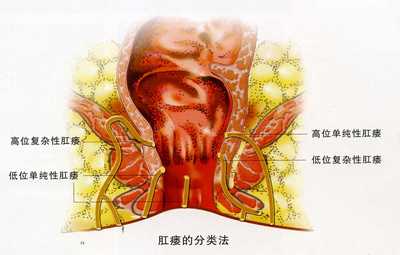 肛瘘是怎么引起的 得了肛瘘严重吗