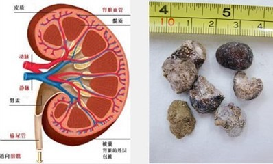 尿结石的治疗方法分析 尿结石最佳治疗方法