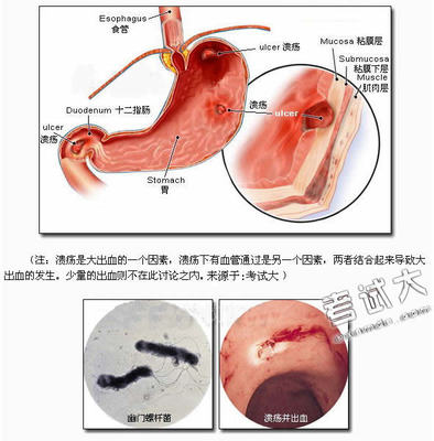 消化性溃疡 消化性溃疡和胃溃疡