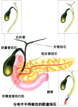 胆囊炎是怎么造成的无锡 胆囊炎怎么检查