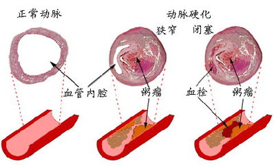 锻炼健康讲座1（赵之心）—— 动脉硬化和静脉曲张的运动指导 硬化剂治疗静脉曲张