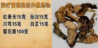 治疗黄褐斑的外敷面膜：红景天面膜 ；延缓皮肤早衰方：二至丸加味