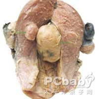 子宫肉瘤的治疗原则 子宫肉瘤b超特点