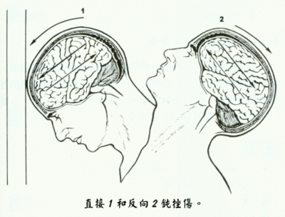 脑震荡治疗秘方6则 轻微脑震荡怎么治疗