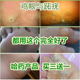 鸡眼传染吗?鸡眼膏怎么用? 鸡眼膏怎么贴