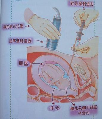 我的羊水穿刺经历 羊水穿刺经历