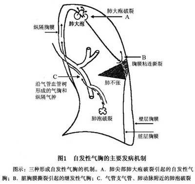 什么是自发性气胸最常见的症状？ 自发性气胸的常见病因