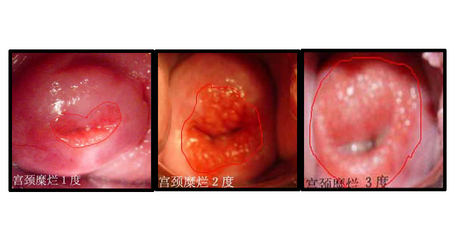 宫颈糜烂——一个过时的疾病 宫颈糜烂疾病治疗