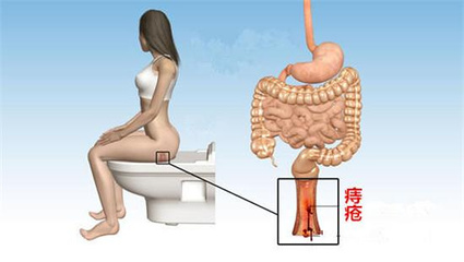 产后痔疮 产后痔疮可以用什么药